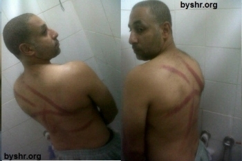 Photos were released by rights groups of Naji Fateel bearing marks of torture in detention., Bahrain Youth Society for Human Rights (BYSHR)