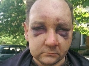 Aleksandr Vovk, member of Independent Trade Union of Ukrainian Miners from Novogradovka, was abducted by anti-Kiev forces on May 4 and released on May 5. While in captivity he was badly beaten by his captors., © 2014 Human Rights Watch