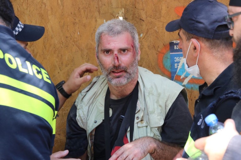 An injured journalist is seen after far-right demonstrators attacked him during an anti-Pride protest, in Tbilisi, Georgia, 5 July 2021, Davit Kachkachishvili/Anadolu Agency via Getty Images
